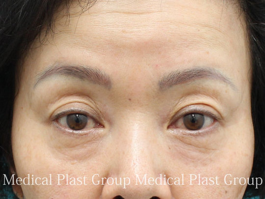 眉毛下切開法 眉下切開法 眉下リフト による瞼のたるみ取りについて プラストクリニック 眉毛下切開法 眉下切開法 眉下リフト による瞼のたるみ取りについて プラストクリニック