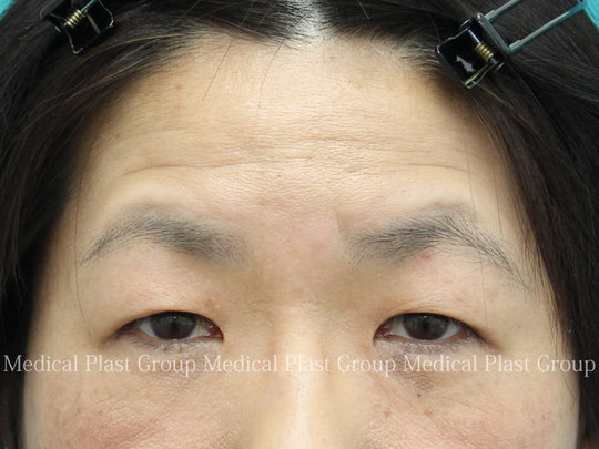 まぶたのたるみを二重切開でとる方法 プラストクリニックのまぶたのブログ 形成外科医が書いたまぶたのお役立ちサイト