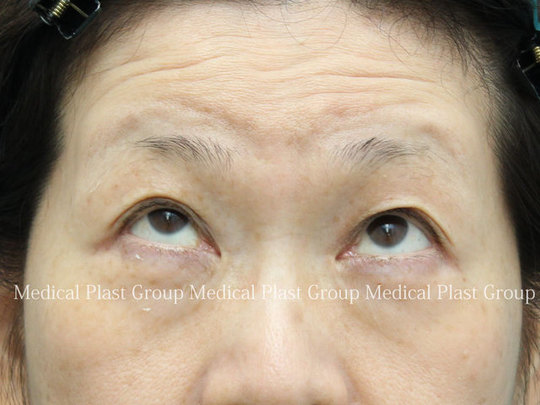 左右差のある眼瞼下垂症に切らない眼瞼下垂症修正術を行った症例