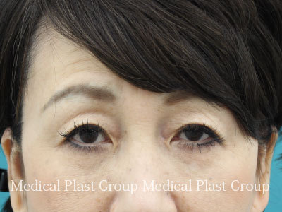 切らない眼瞼下垂症手術後の修正について プラストクリニックのまぶたのブログ 形成外科医が書いたまぶたのお役立ちサイト