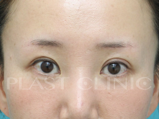眉毛下切開法 眉下切開法 眉下リフト による瞼のたるみ取りについて プラストクリニック