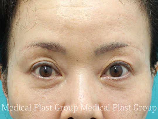 眉毛下切開法 眉下切開法 眉下リフト による瞼のたるみ取りについて プラストクリニック
